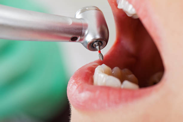 Best Urgent Care for Lost Fillings or Crowns in Westhaven Moonstone, CA